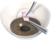 Glaucoma Surgery | Glaucoma Surgeon | Shawano WI | Green Bay WI | Marinette WI