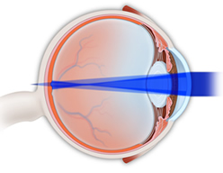 Astigmatism Treatment | Diabetic Eye Care | Dry Eye Treatment | Shawano WI | Green Bay WI | Marinette WI | Iron Mountain MI