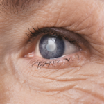 Tower Clock Eye Center cataract surgery evaluation testing