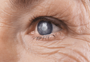 Tower Clock Eye Center cataract surgery evaluation testing