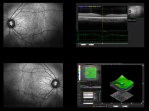 Optical Coherence Tomography OCT, scan