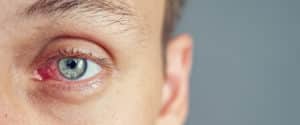 Tower Clock Eye Center doctors treat dry eye syndrome.